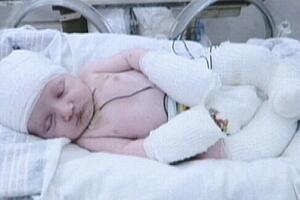 Jednomjesečni Brodi Kurtis, beba rođena bez kože