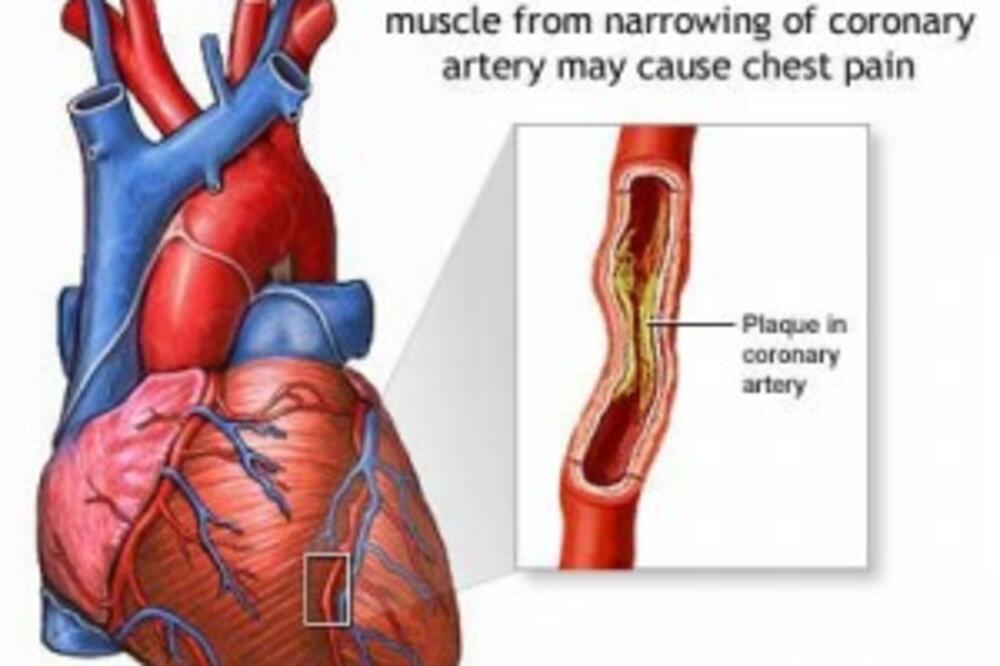 holesterol, Foto: Www.allmedicaldiseases.com