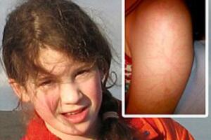 Djevojčicu (10) pogodio grom, prošao kroz tijelo, izašao na nožni...