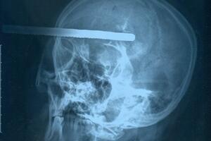 Preživjela nakon što joj je metalna šipka prodrla u lobanju