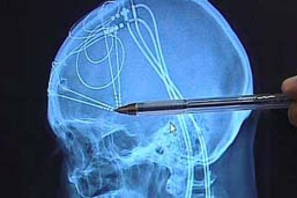 mozak, Foto: Bbc.co.uk