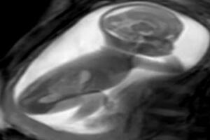 Istraživanje: Kako snimiti srce bebe u maminom stomaku