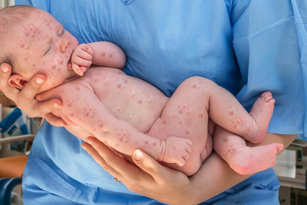 Sve je više ljudi koji odbijaju da vakcinišu djecu, što je jedan od glavnih uzroka porasta oboljelih od malih boginja u svijetu, Foto: BBC