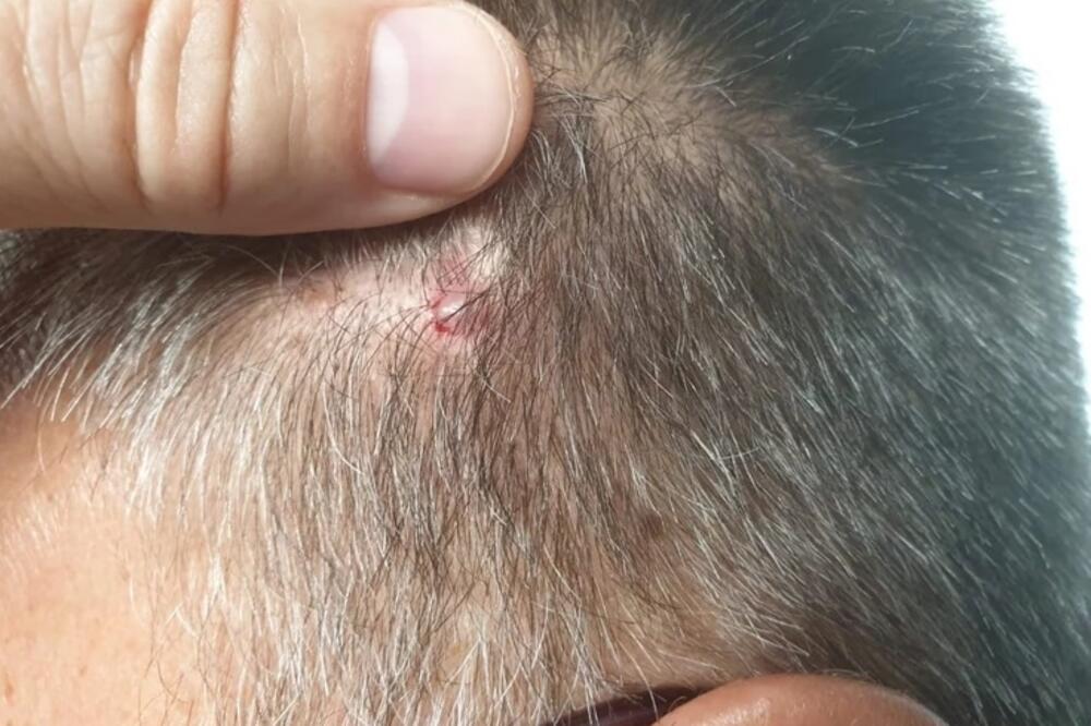 Jedan od čelnika Zvezde pokazuje povredu, Foto: Blic sport