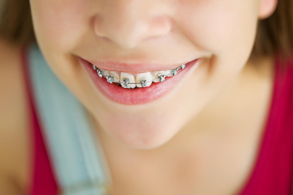 Mnogi roditelji ne mogu da priušte nabavku fiksne zubne proteze, Foto: Shutterstock