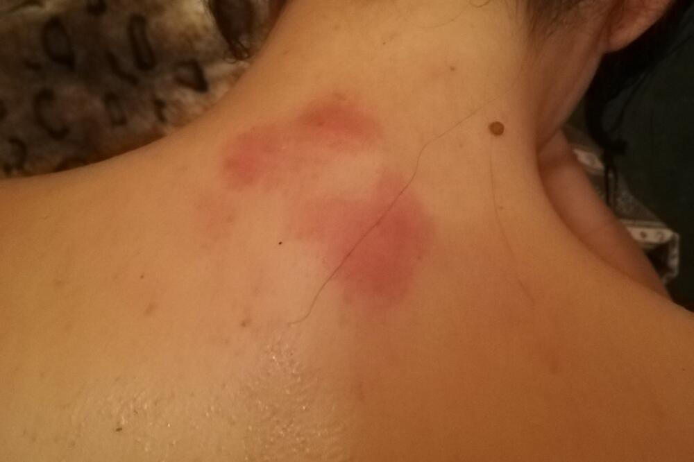 Brojne povrede konstatovane i u Kliničkom centru: Sekulićeva nakon prebijanja, Foto: Privatna arhiva, Privatna arhiva