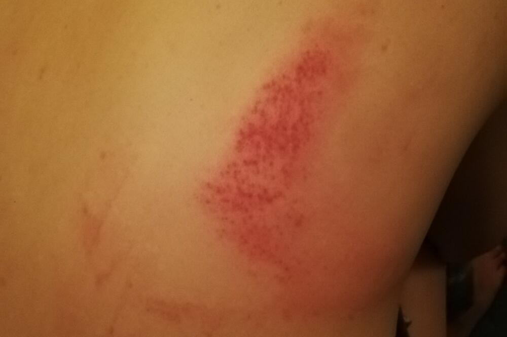 Zadobila hemetome po cijelom tijelu, Foto: Privatna arhiva