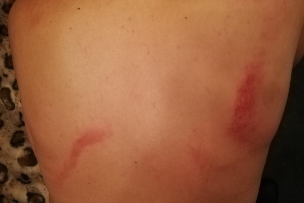 Brojne povrede konstatovane i u Kliničkom centru: Sekulićeva nakon prebijanja, Foto: Privatna arhiva, Privatna arhiva