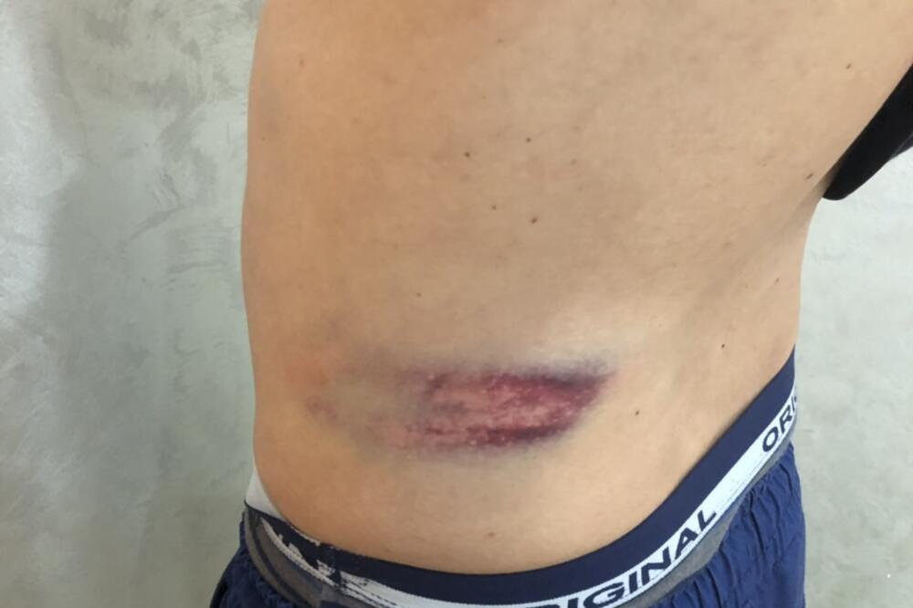 Povrede Maraša, Foto: Privatna arhiva