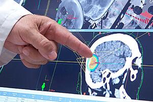 U KCCG počela primjena nove metode zračenja tumora