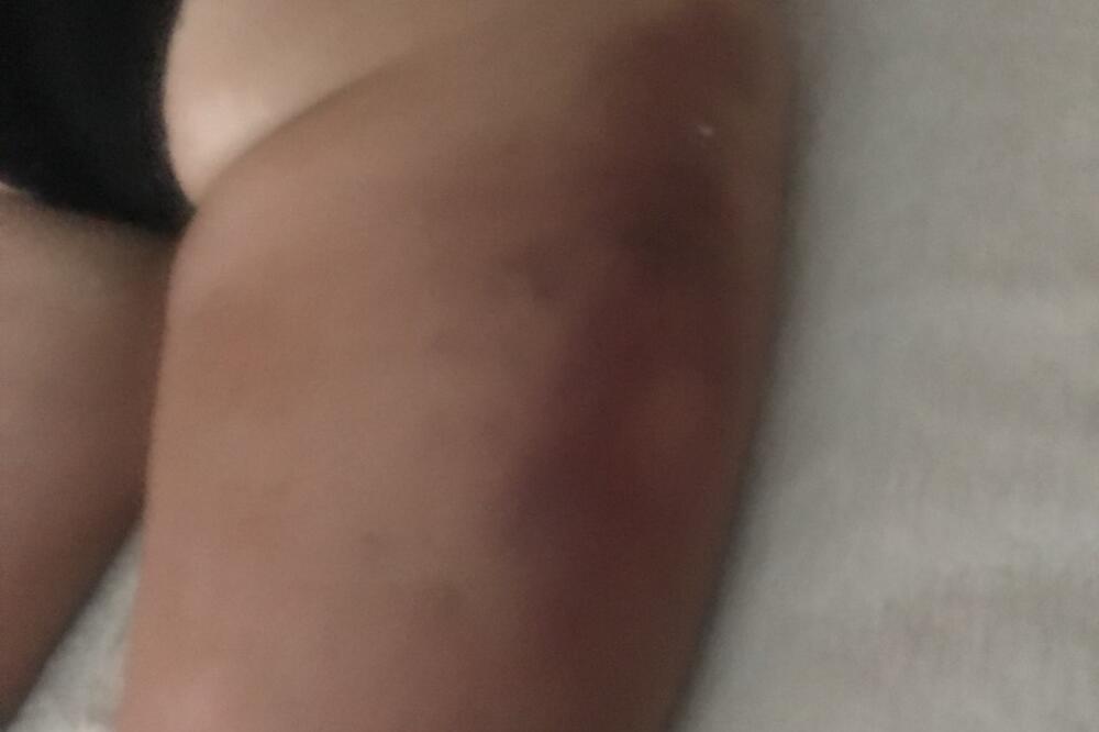 Noga strankinje nakon tretmana, Foto: Privatna arhiva