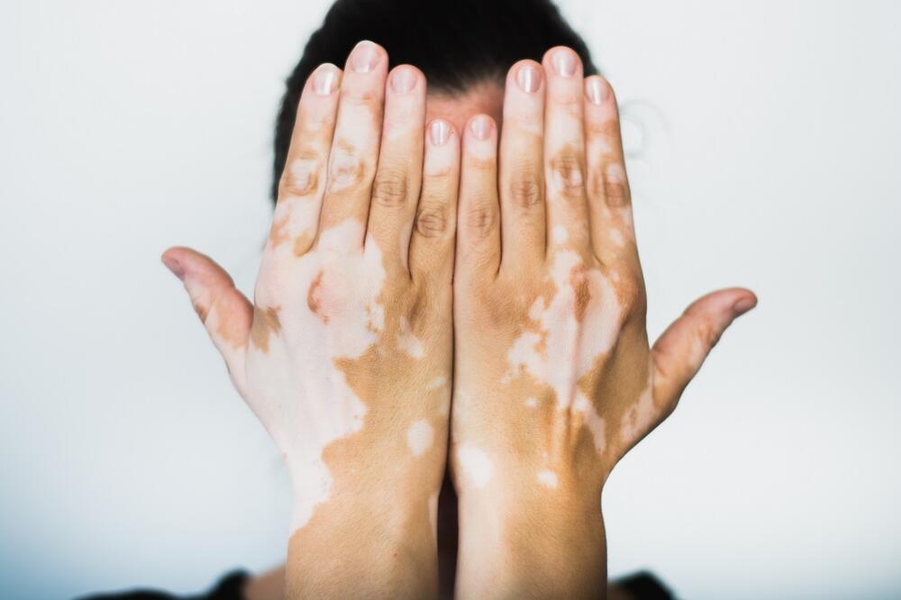 vitiligo, Foto: Shutterstock