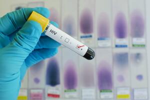 Belgijski naučnici tvrde da su otkrili gdje se krije virus HIV-a