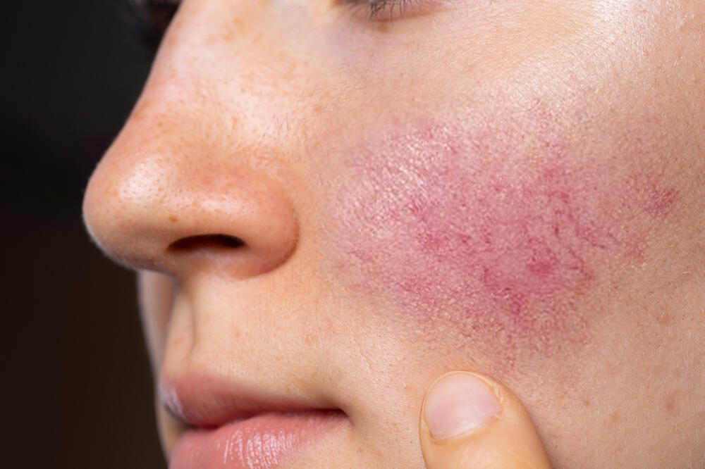 Ovu kožnu bolest nije moguće u potpunosti izliječiti, Foto: Shutterstock