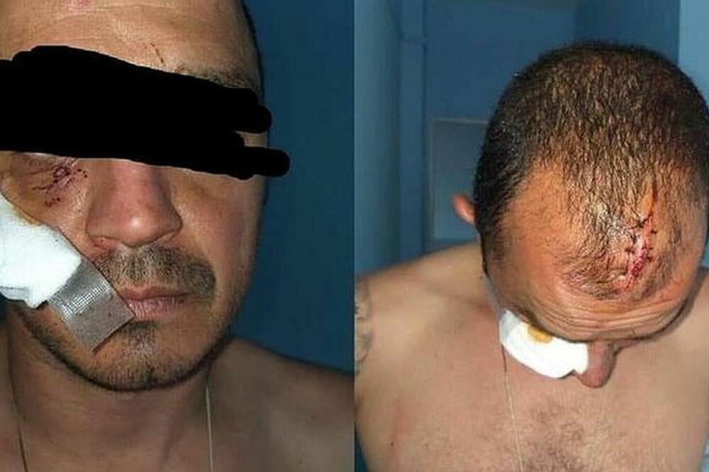 Povrede koje je Ivanović zadobio od policijskih službenika, Foto: Varvari