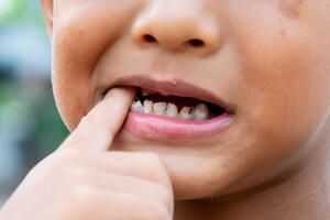 Mnogi se i dalje pitaju: Da li treba popravljati mliječne zube?