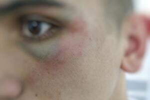 Maloljetnik pretučen zbog protesta u Zeti, tvrdi da nije bio...