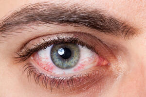 Zbog 'buljenja' u ekrane: Kako pomoći crvenim i nadraženim očima