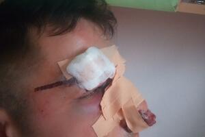 Omeroviću polomili nos u tuči