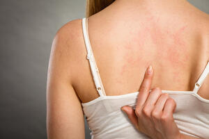 Bolesti kože čest medicinski problem