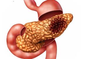 Tumor insulinom teško lokalizovati