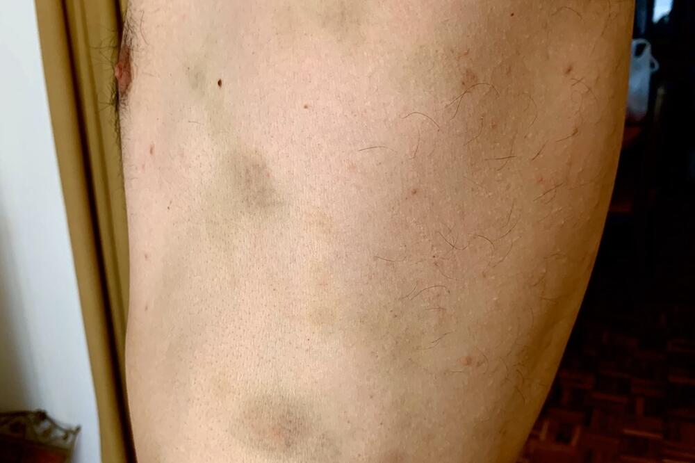 M. B. nakon policijske obrade, Foto: Privatna arhiva