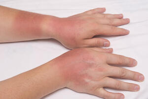Upozorenje: Ne koristite gel za dezinfekciju ruku na suncu