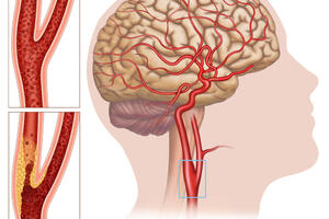 Karotidna bolest: Opasno suženje krvnih sudova vrata