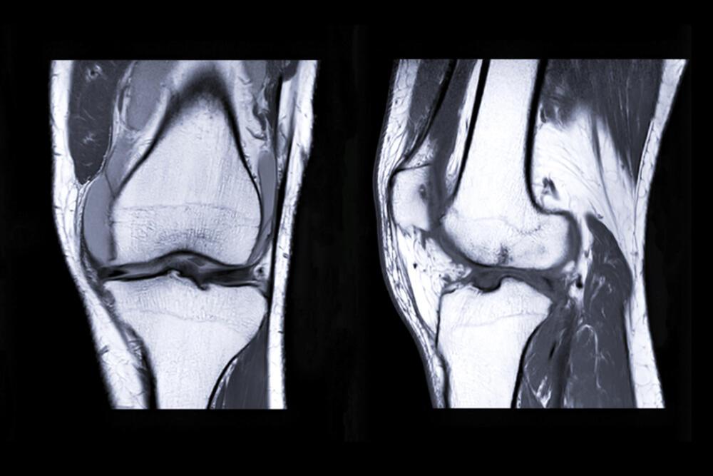 Magnetna rezonanca hrskavice koljena.