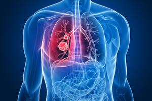 Zašto i mnogi nepušači dobiju kancer pluća?