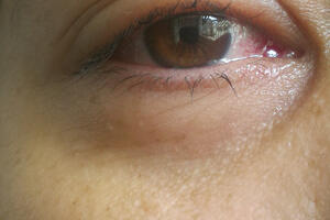 Ako su vam oči natečene: To može biti znak ove ozbiljne bolesti