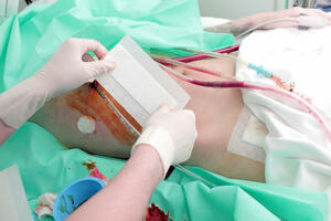 KCCG: Obnovljena mogućnost transplantacije bubrega od srodnog...
