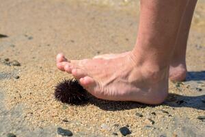Evo šta da radite ako nagazite na ježa ili vas opeče meduza
