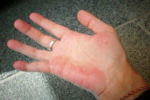 Crveni dlanovi: Nekad su simptom ozbiljne bolesti