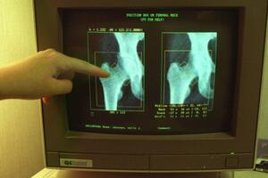 Šta je osteoporoza i šta utiče na gustinu kostiju