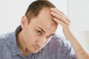 Ako pijete ova pića začajno povećavate šanse da budete ćelavi