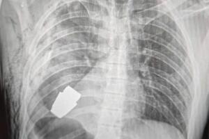 Neeksplodirana granata uklonjena iz grudi ukrajinskog vojnika