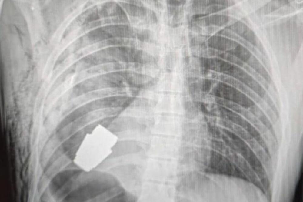 Rendgen pokazuje da je granata blizu srca vojnika, Foto: Facebook/Ukraine medical force command