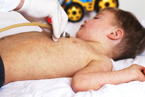 Dolazak malih boginja u Crnu Goru sasvim izvjestan: Bez vakcina,...