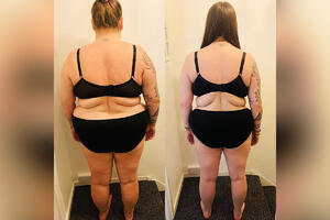 Do čega sve dovode "nesmotrene“ operacije za gubitak kilograma