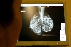 Novi lijek za rak dojke smanjuje rizik od povratka bolesti