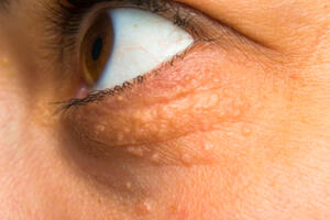Ksantelazma ili masne naslage oko očiju: Zašto nastaju i kako ih...