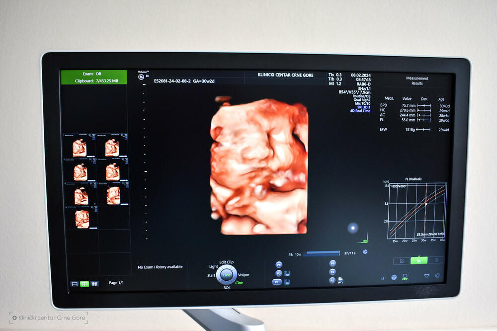 Prikaz na ultrazvuku, Foto: Klinički centar Crne Gore