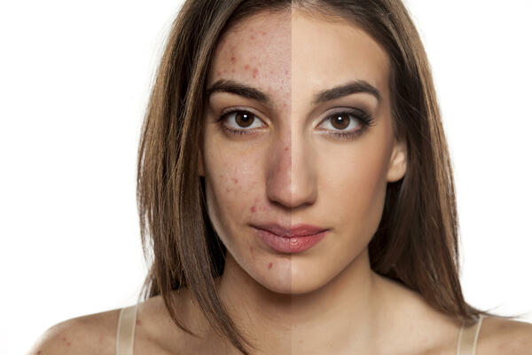 Face as a mirror: How does stress affect the skin?