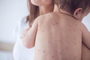 The contacts are being investigated, and the epidemic is at the door: A case of measles "imported"...