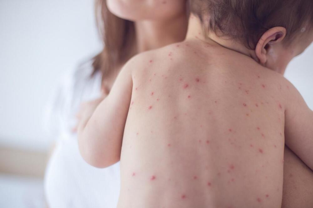 Only a fifth of children born in 2022 were vaccinated against measles, Photo: s