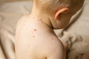 Two suspected cases tested negative for measles