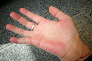 Look at your hands: Redness, blisters... can be signs...