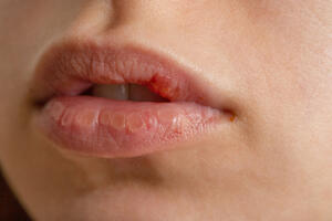 It happens to many: What if the balm dries out the lips even more