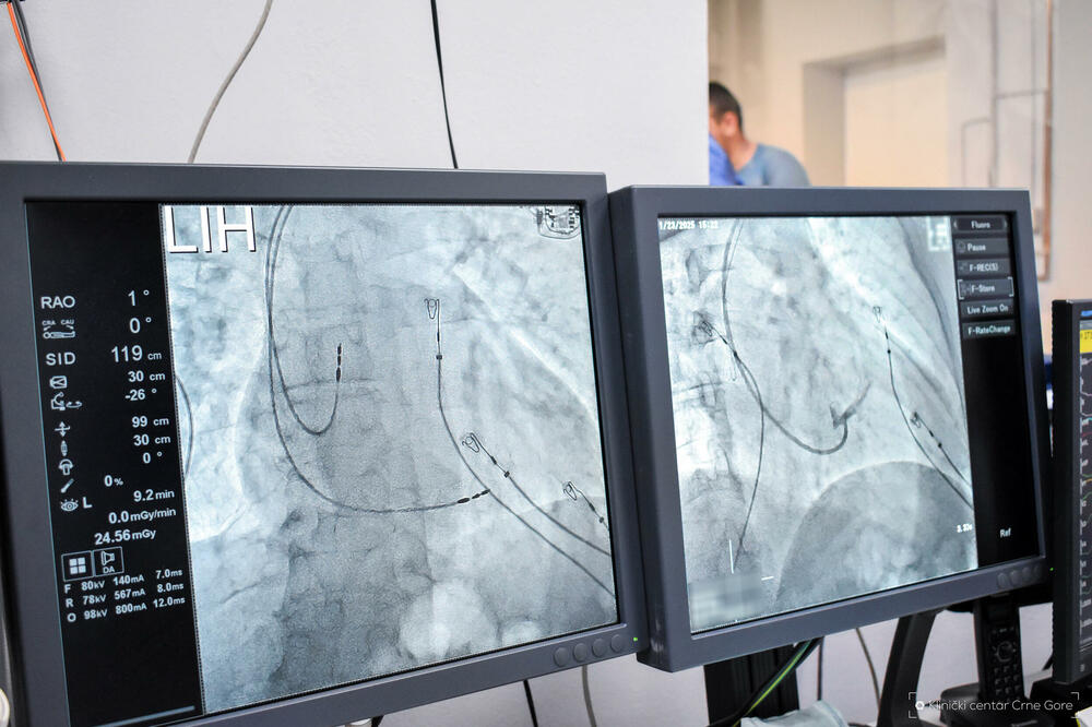 <p>"U pitanju je nova vrsta pejsmejkera, sprovodnog sistema srca. Ovi aparati srčanom mišiću isporučuju električne impulse na način koji mnogo više odgovara prirodnom srčanom radu u odnosu na standardne pejsmejkere. Ugrađuje se ispod kože u grudnom dijelu kod pacijenata koji imaju ekstremno usporen srčani rad", ističe se u saopštenju KCCG</p>